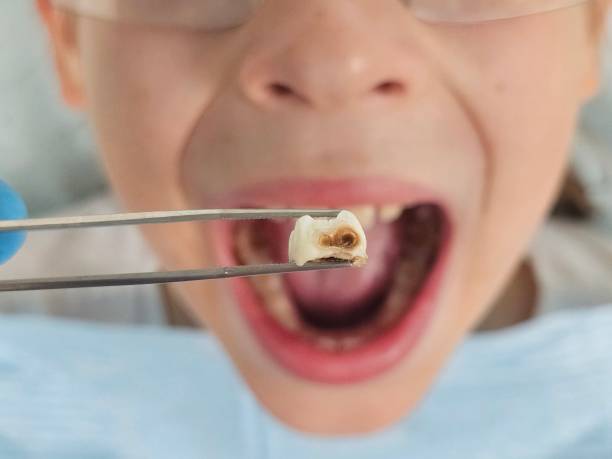Best Emergency Dental Extractions in Foresthill, CA